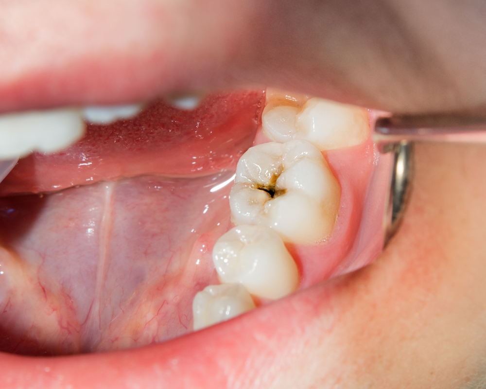 Composite Fillings