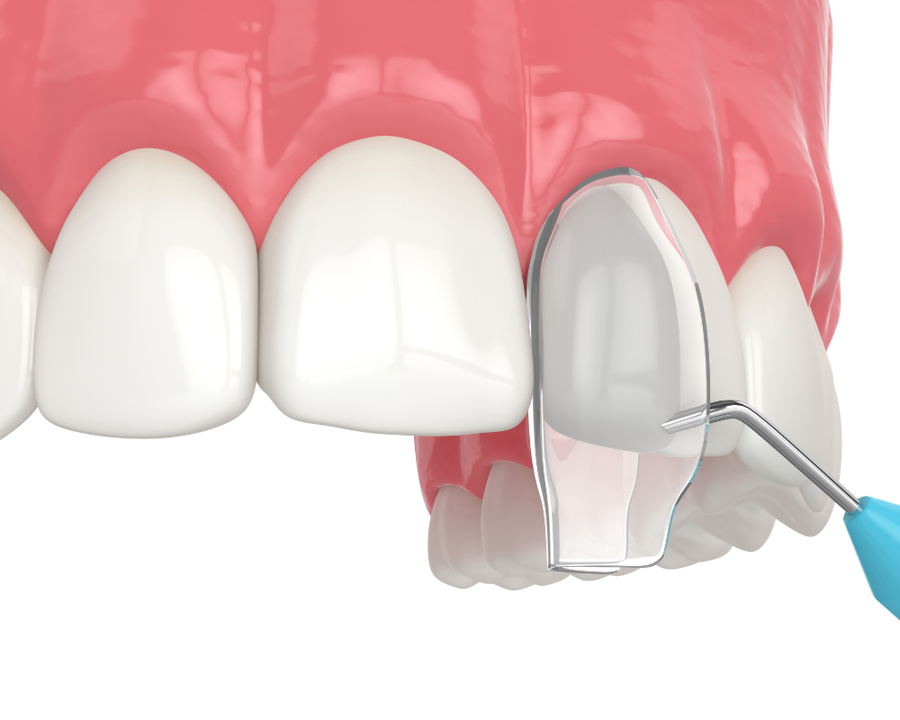 Dental Bonding at Encinitas Family Dentistry