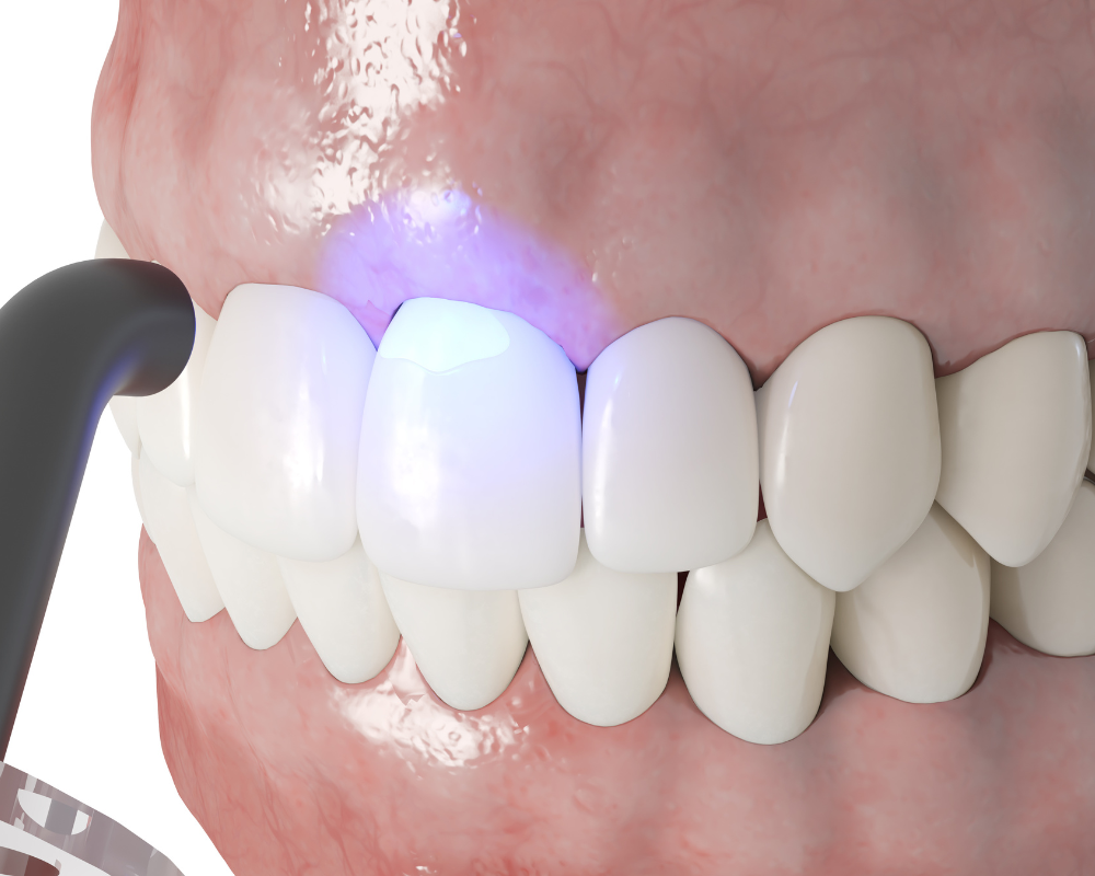 Dental Bonding