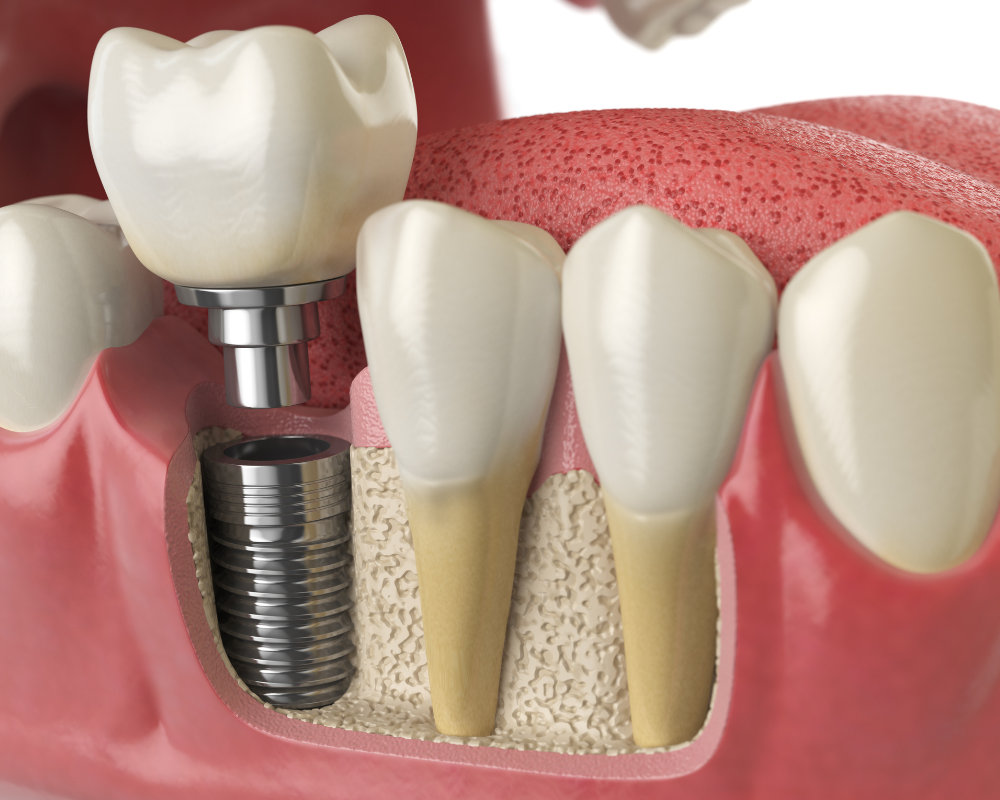 Dental Implants at Gregory Skeens, DDS