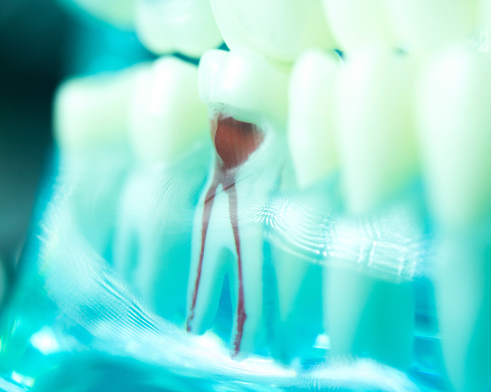 Root Canal Therapy at Encinitas Family Dentistry