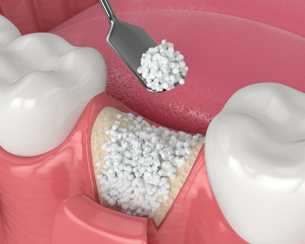 Tooth Extractions and Bone Grafting
