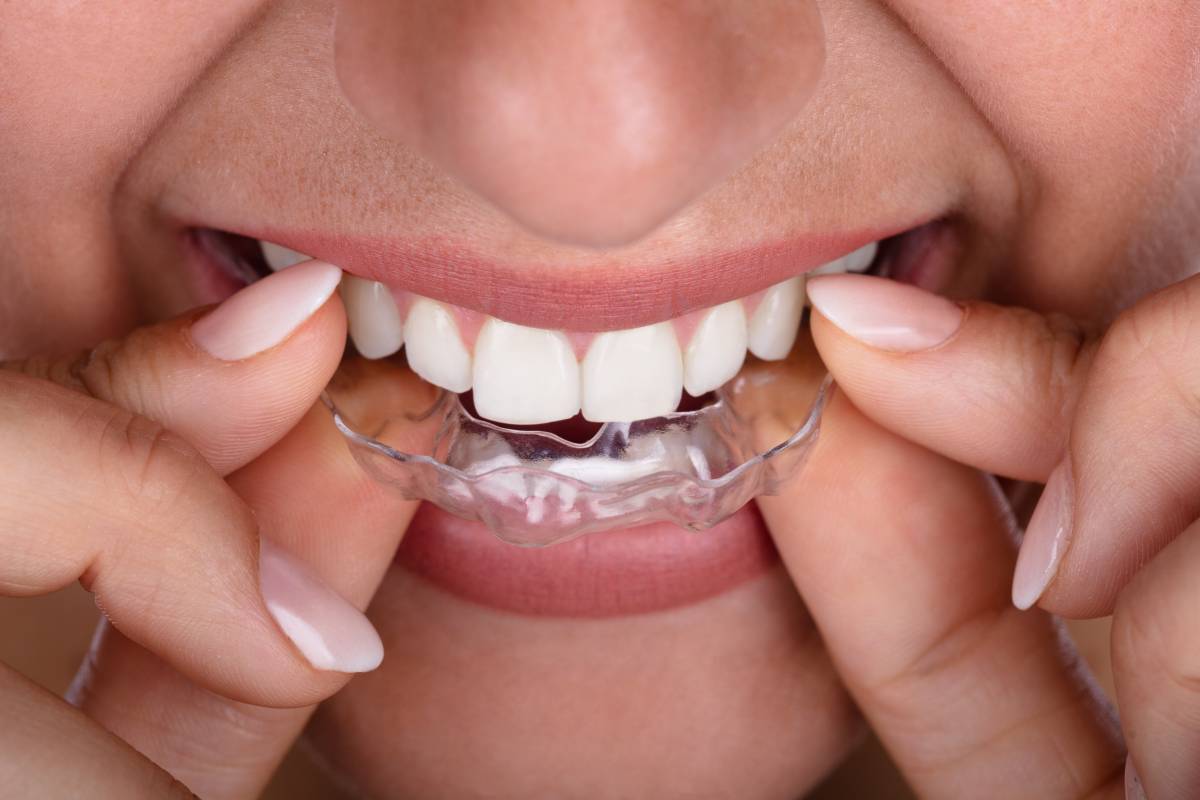 How Elastics Work Differently in Invisalign and ClearCorrect vs Braces